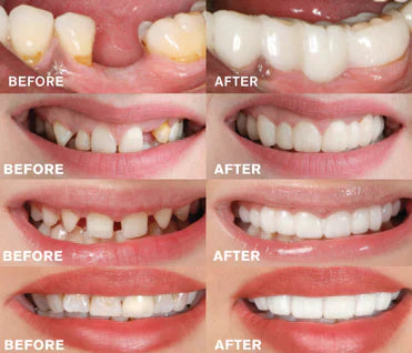 SnapOn Gebiss – Easy-Click Dentalprothese für ein selbstbewusstes, strahlendes Lächeln
